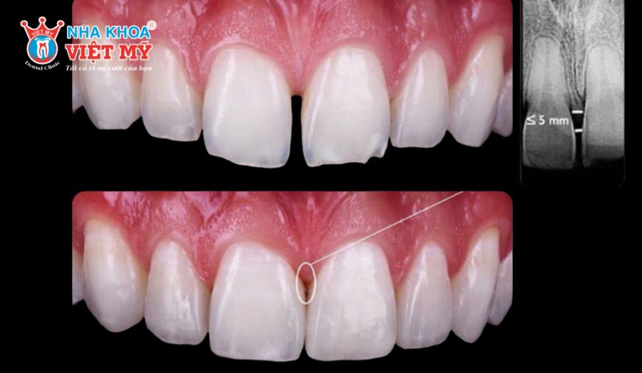 Trám răng thưa là một phương pháp nha khoa thẩm mỹ an toàn, tiết kiệm