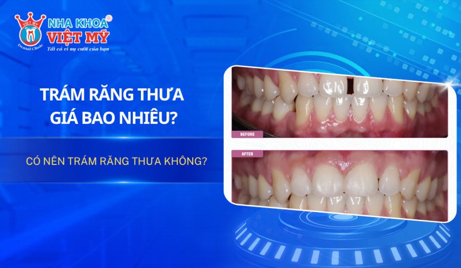 Trám răng thưa hiện nay giá bao nhiêu