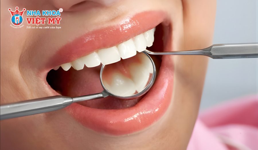 Nhựa composite là vật liệu phổ biến trong trám răng thưa thẩm mỹ