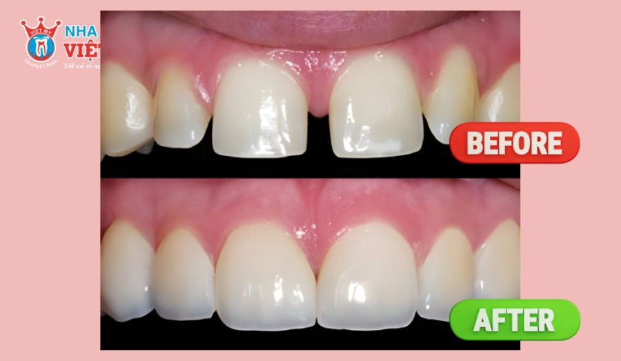 Cần chăm sóc đúng cách sau khi trám răng để giữ độ bền lâu dài