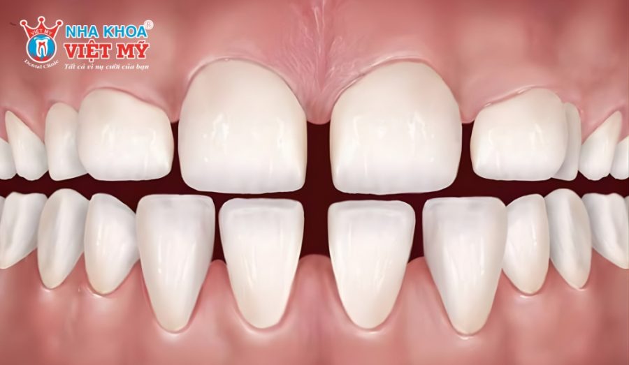 Trám răng sử dụng vật liệu chuyên dụng để lấp đầy những khoảng trống, vết nứt