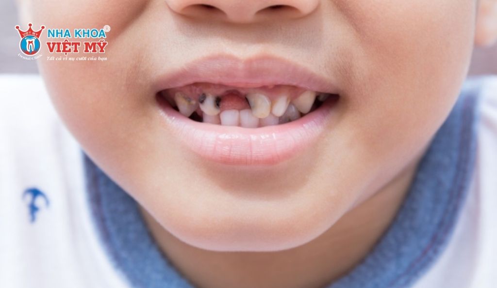 Phụ huynh nên làm gì khi trẻ bị sâu răng sữa?