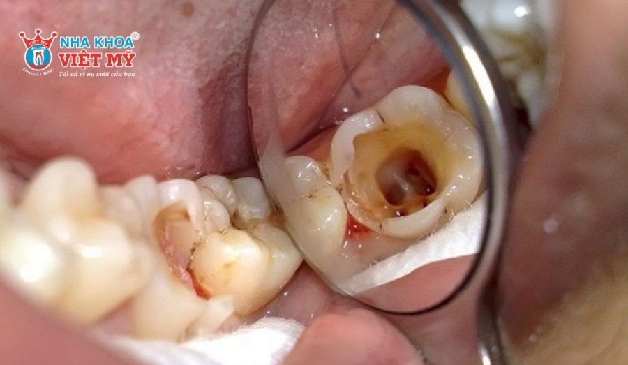 Răng sữa bị sâu quá nặng cần được nhổ bỏ để không ảnh hưởng đến nướu và răng khác