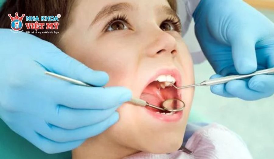 Trám răng cho trẻ đối với trường hợp sâu nặng