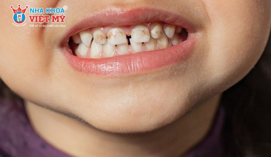 Răng sữa của trẻ mới mọc đã bị đen do nhiễm fluor quá mức
