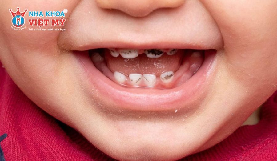 Răng trẻ mới mọc đã bị đen do răng sữa khởi phát sớm