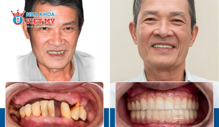 Mức giá trồng răng Implant cho người cao tuổi sẽ chênh lệch tùy gói dịch vụ