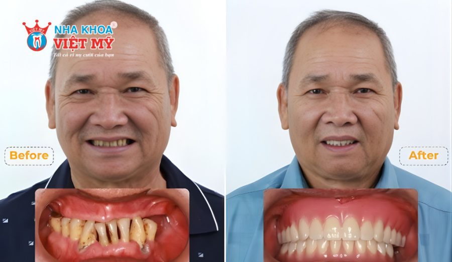 Trồng răng Implant cho người cao tuổi có an toàn và hiệu quả không