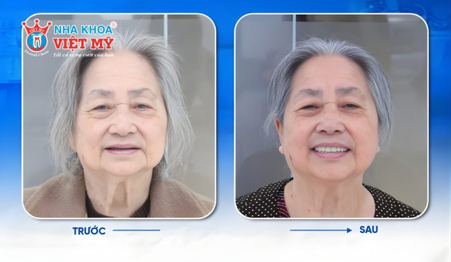 Cần tìm đơn vị trồng răng Implant cho người cao tuổi uy tín, chuyên nghiệp