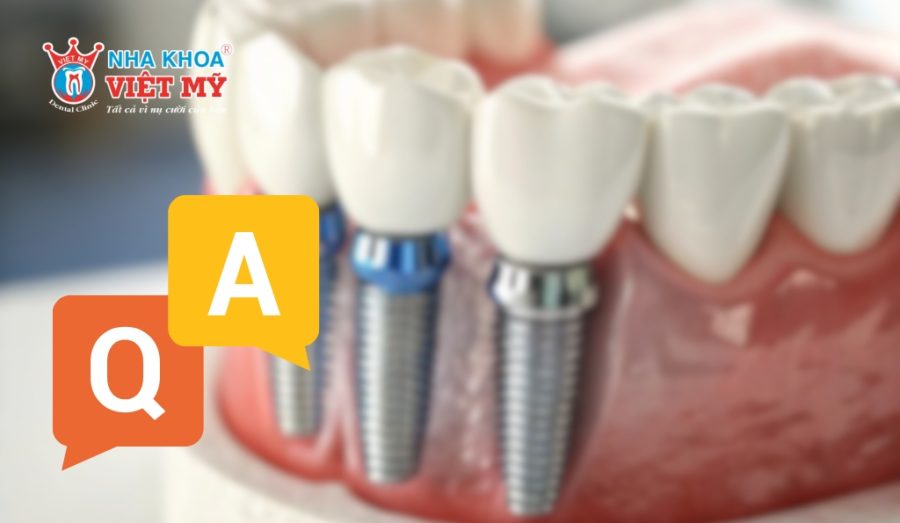 Câu hỏi liên quan về việc trồng răng Implant