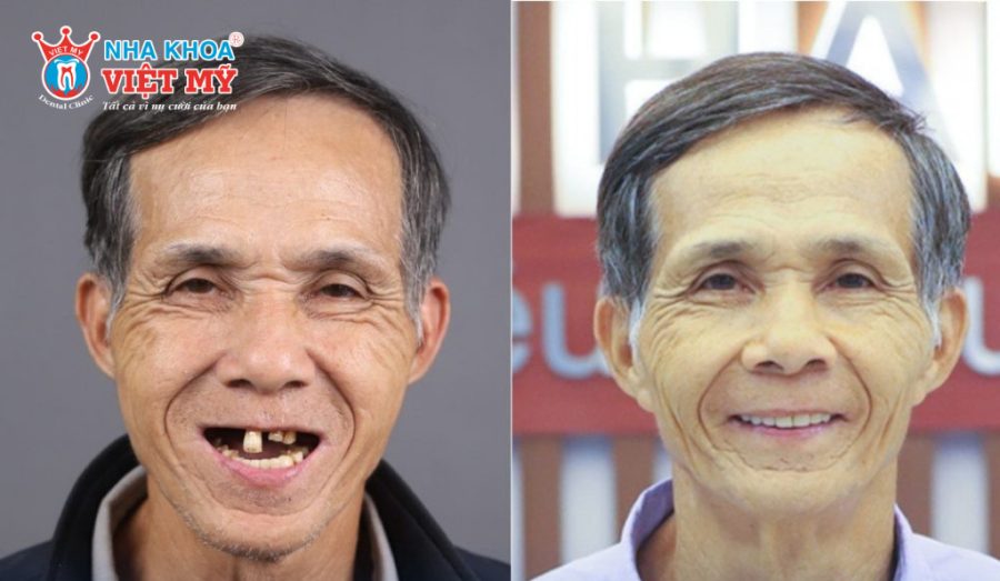 Người cao tuổi có bệnh lý toàn thân làm răng Implant được không