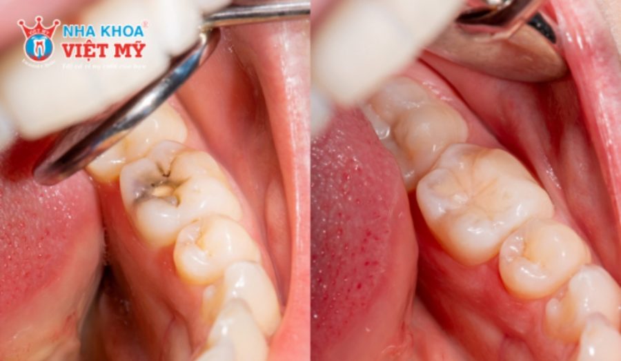 Trám răng giúp phục hồi mô răng bị mất