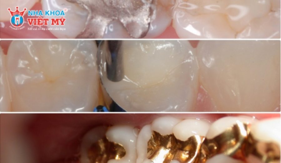 Các vật liệu trám răng được dùng nhiều nhất hiện nay