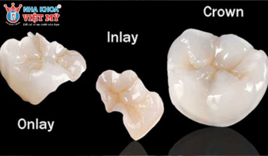 Trám răng Inlay/Onlay bằng sứ