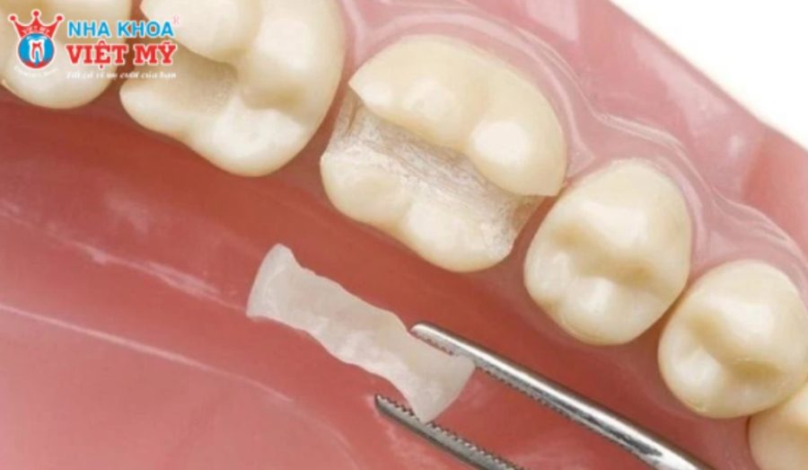 Nên chọn vật liệu trám răng nào phù hợp