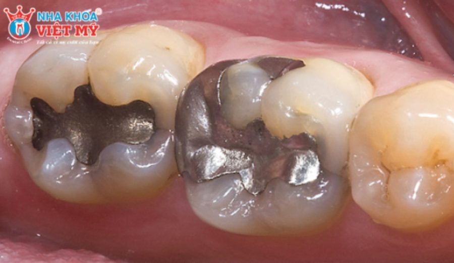 Chất hàn răng Amalgam truyền thống