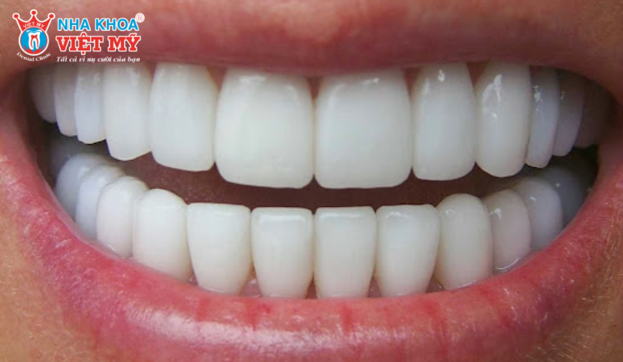 Chi phí bọc răng sứ hiện nay tùy thuộc vào nhiều yếu tố