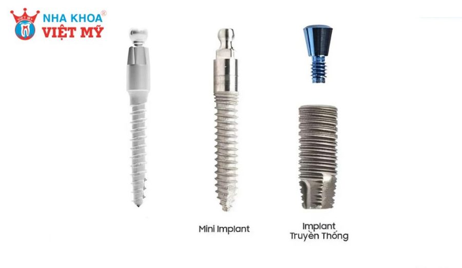 Mini Implant khác Implant thông thường ở kích thước và vai trò lâm sàng, chủ yếu dùng để neo giữ hỗ trợ chứ không thay thế chân răng lâu dài.
