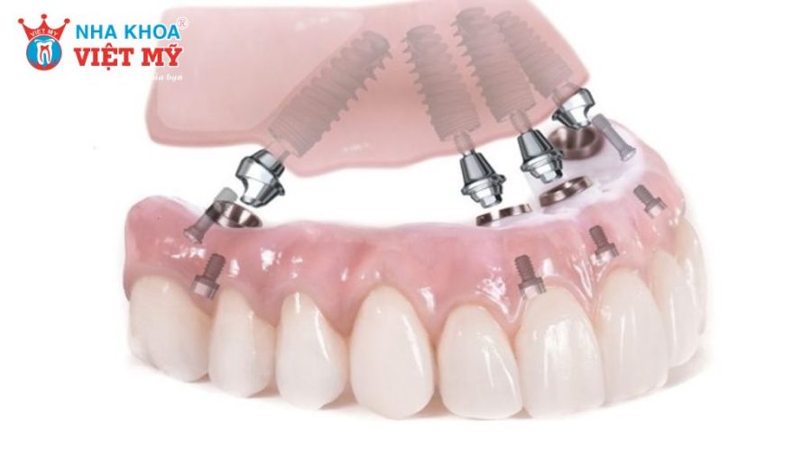 Mini Implant có chi phí thấp hơn Implant thường, phù hợp cố định hàm giả hoặc phục hình đơn giản.