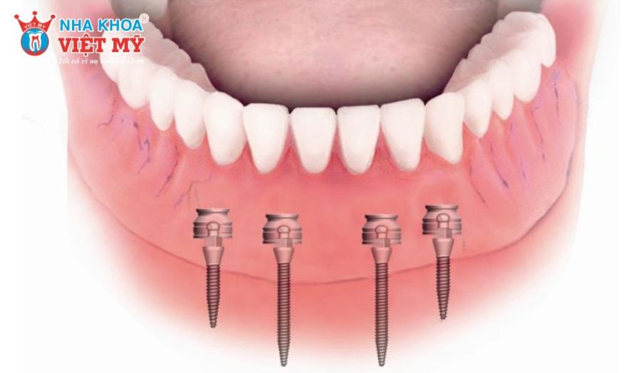 Mini Implant là trụ Implant có đường kính nhỏ từ 1,8–3 mm, giúp cấy ghép ít xâm lấn và rút ngắn thời gian thực hiện
