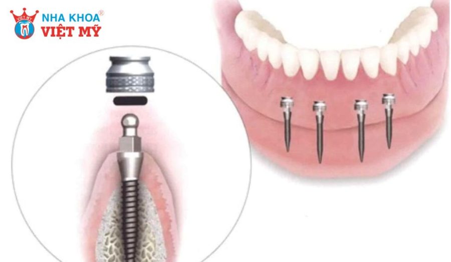Mini Implant ít xâm lấn, giảm đau sưng và hồi phục nhanh.