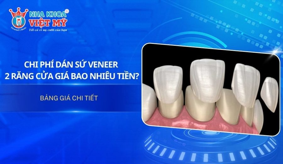 Chi phí dán sứ Veneer 2 răng cửa giá bao nhiêu tiền?