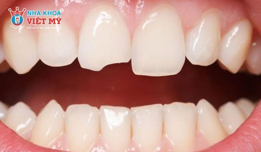 Cần dán sứ Veneer cho 2 răng cửa khi răng bị sứt mẻ, vỡ nhẹ