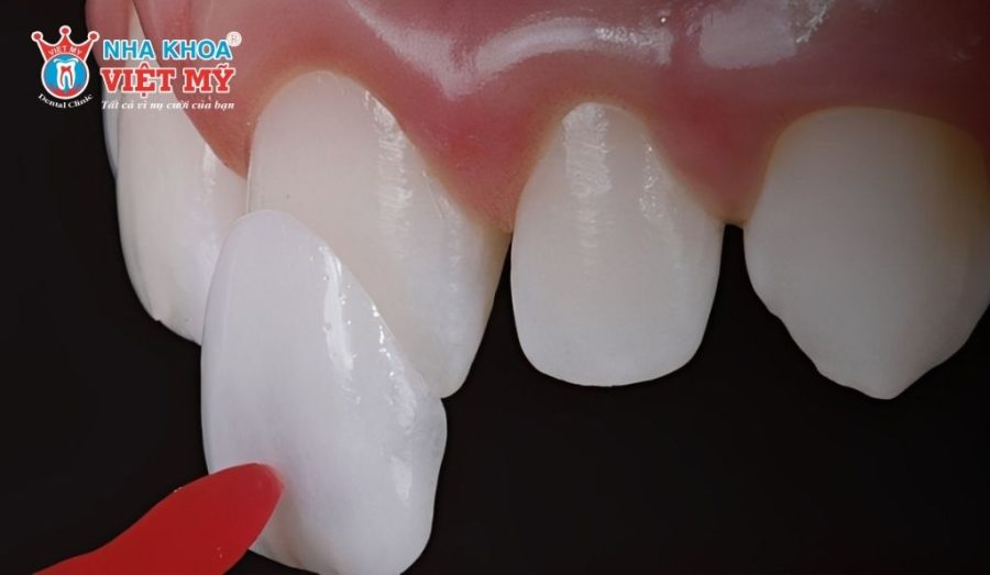 Dán sứ Veneer 2 răng cửa giá bao nhiêu?