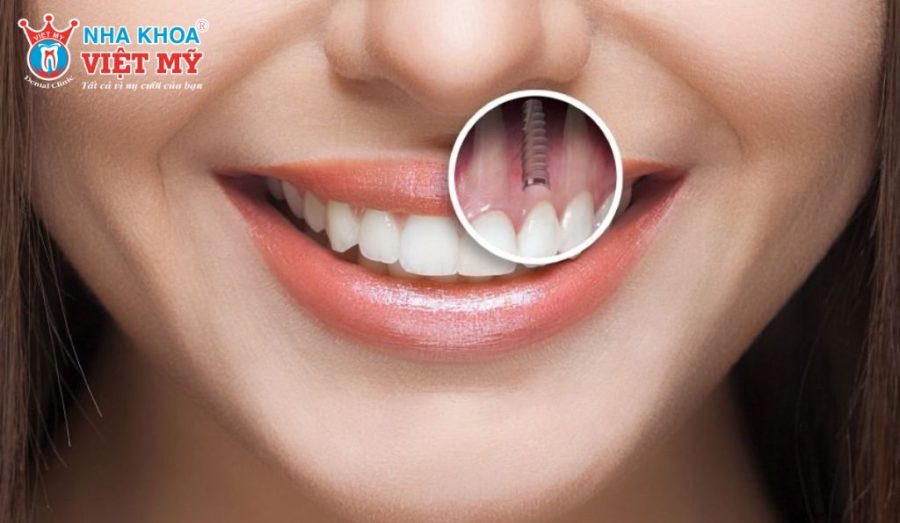 Kỹ thuật cấy ghép răng Implant là cấy ghép chân răng giả bằng vít Implant vào xương hàm để làm trụ nâng đỡ mão sứ giặc hàm giả tháo lắp
