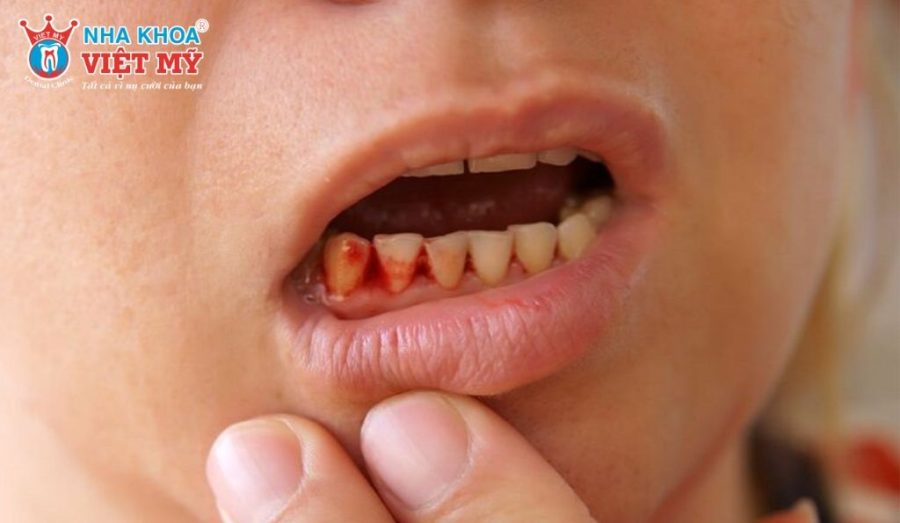 Dấu hiệu bất thường sau khi phẫu thuật cấy ghép Implant