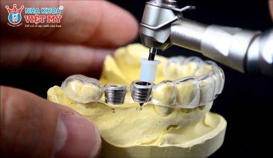 Kỹ thuật cấy Implant bằng máng hướng dẫn