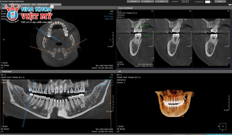 Công nghệ chụp CT ConeBeam 3D