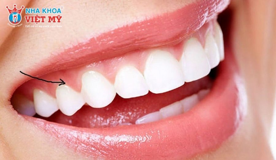 Nướu chưa kịp thích nghi có thể gây ra cảm giác khó chịu