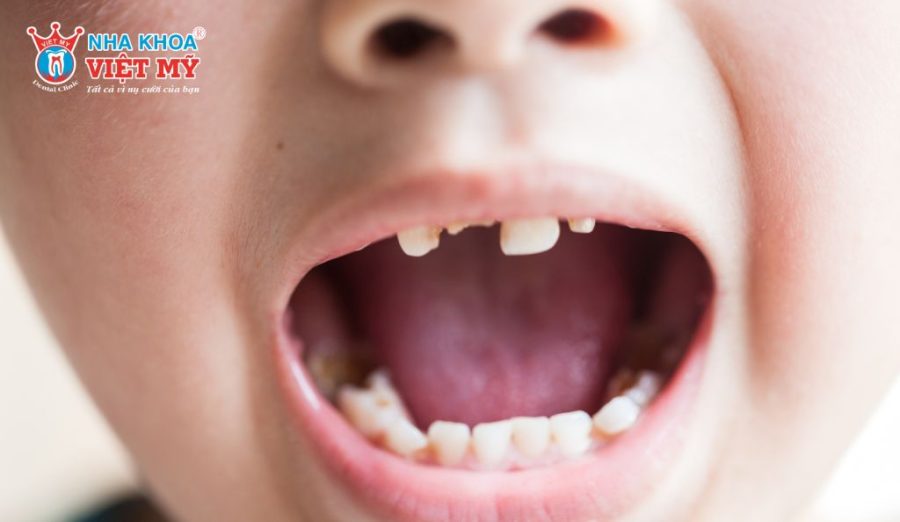 Người dưới 17 tuổi chưa ổn định xương hàm, bọc răng sứ sớm dễ ảnh hưởng phát triển