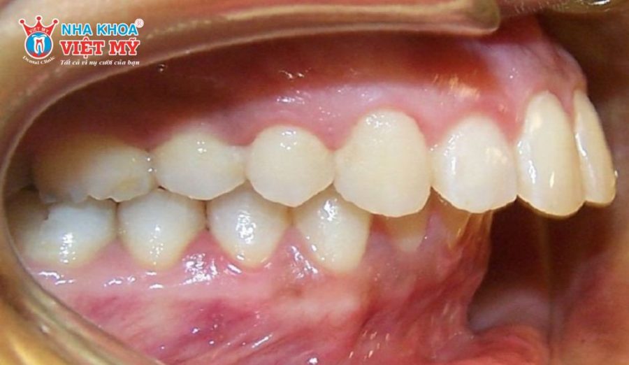 Sai khớp cắn khiến ăn nhai kém, bọc răng sứ không điều chỉnh được cấu trúc hàm