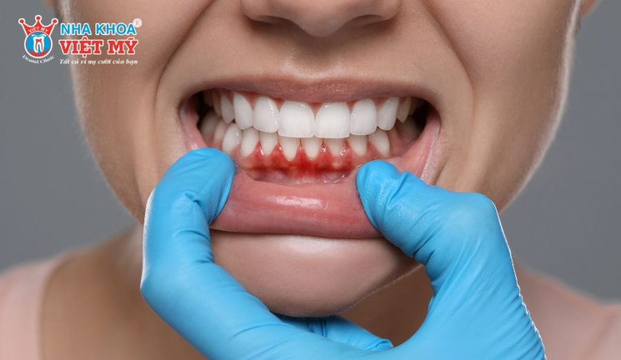 Bệnh nha chu làm răng lung lay, tiêu xương, khiến bọc răng sứ kém bền và dễ thất bại