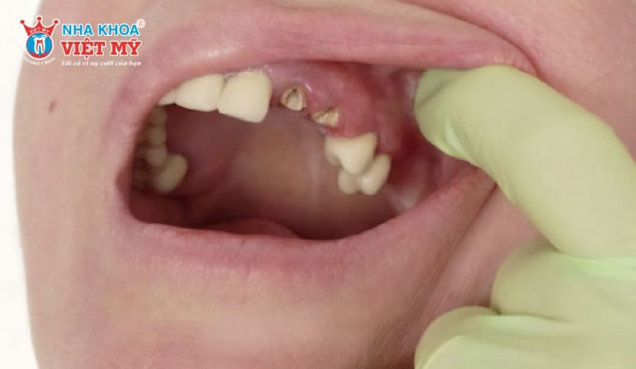 Răng gãy chỉ còn chân không đủ mô trụ, bọc sứ khó bền và không ổn định