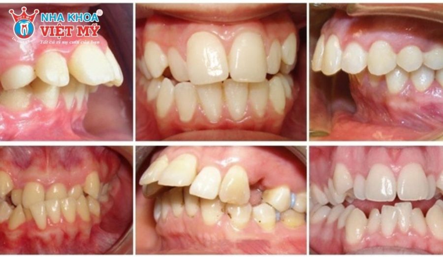 Các trường hợp sai lệch răng không phù hợp để dán răng sứ