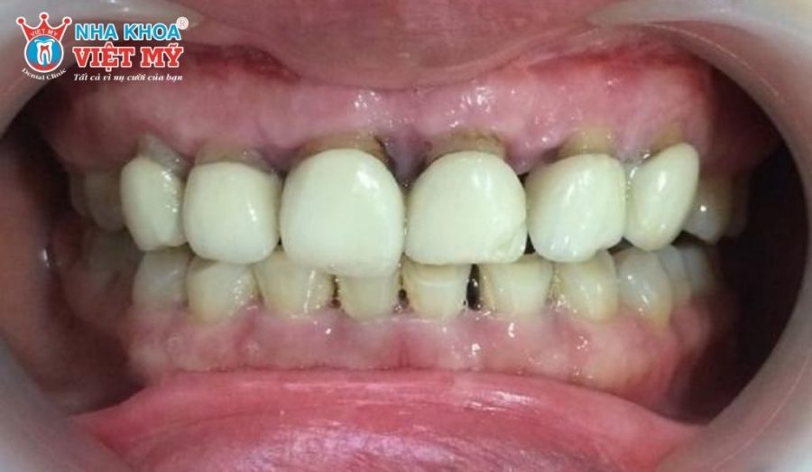 Răng sứ bị lệch, không sát khít do thực hiện sai kỹ thuật