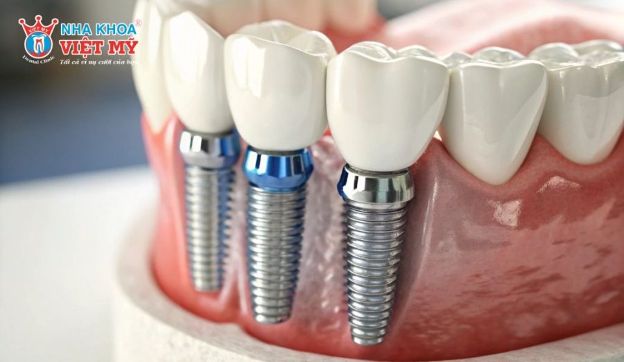 Chi phí trồng răng Implant khá cao và có thể phát sinh ghép xương, nâng xoang