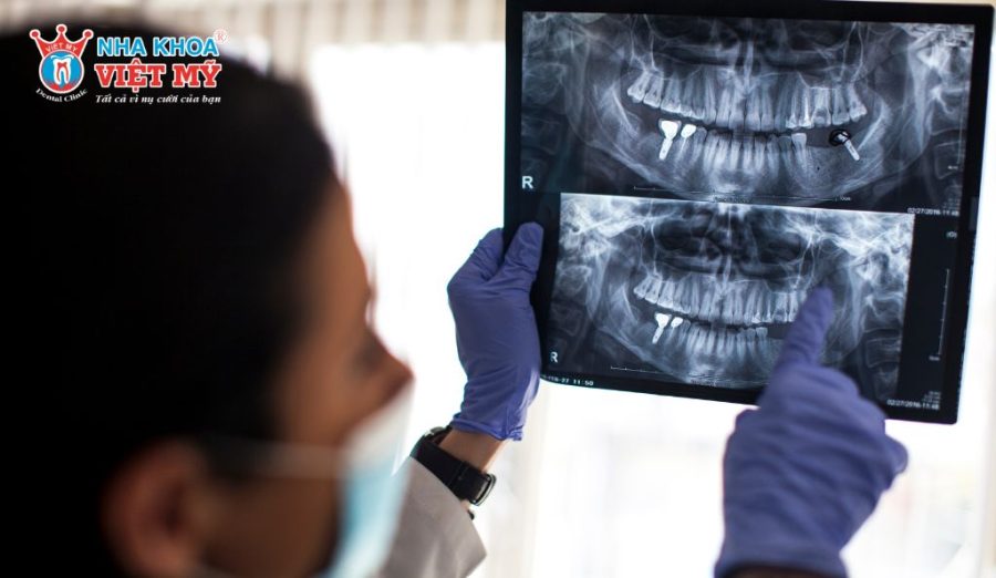 Trồng răng Implant thành công phụ thuộc lớn vào tay nghề bác sĩ để đảm bảo an toàn, chính xác