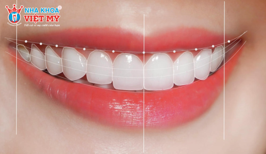 Răng sứ Emax mang lại nụ cười thẩm mỹ với độ trong, bóng, và hiệu ứng chiều sâu tự nhiên