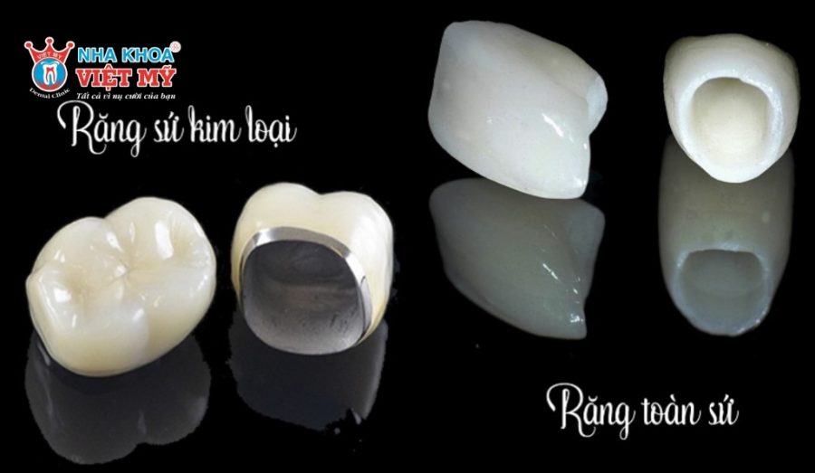 So sánh răng sứ kim loại và răng toàn sứ