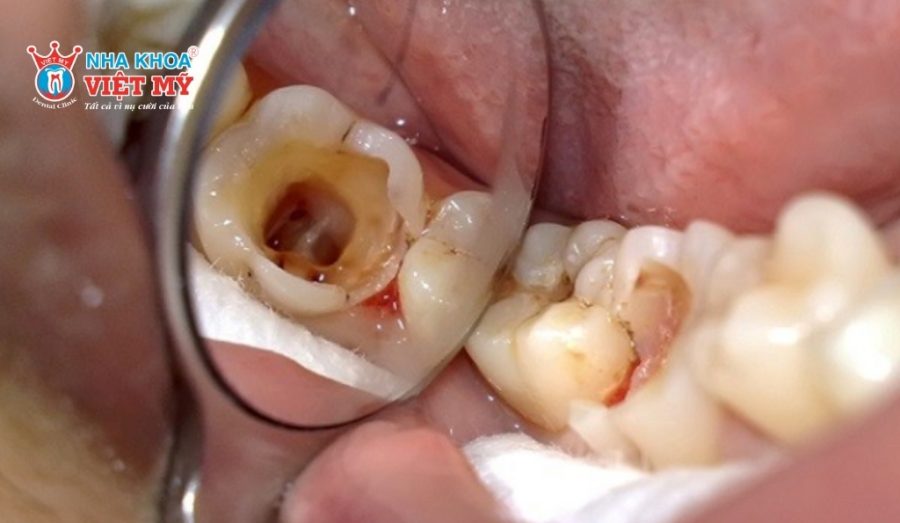 Người già có răng bị sâu, nứt nẻ nên làm răng sứ