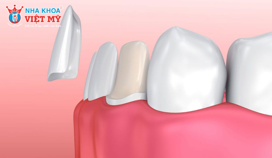 Tìm hiểu những lưu ý khi bọc răng sứ Venus