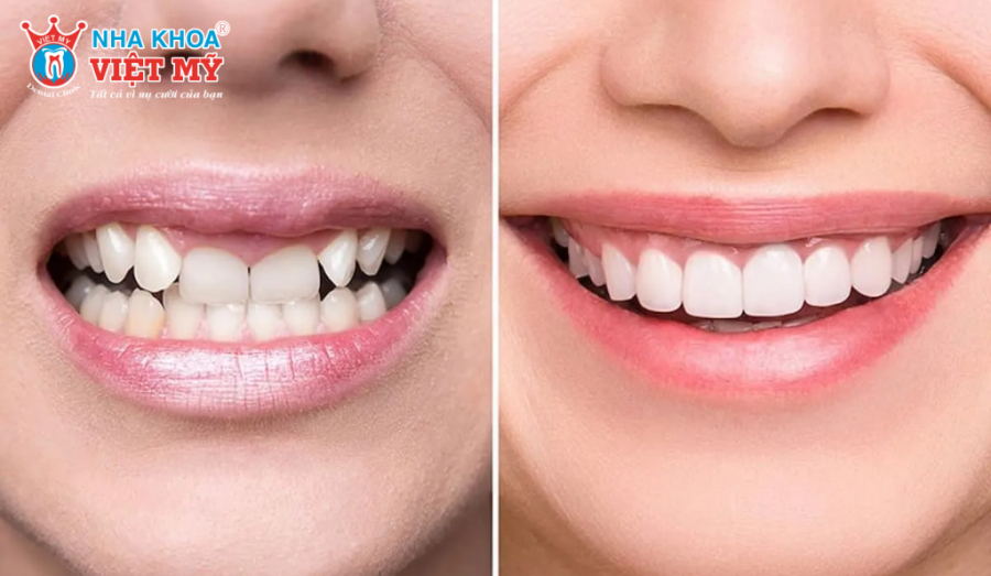 Bên cạnh những ưu điểm nổi bật thì răng sứ Venus vẫn còn nhiều hạn chế