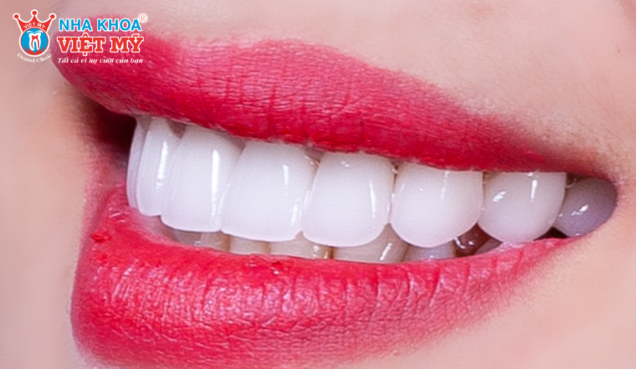 Răng sứ Venus có nhiều loại với các đặc điểm khác nhau