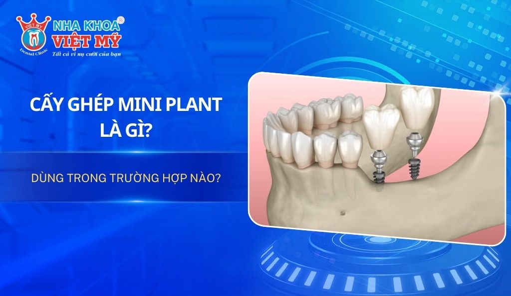 ấy ghép mini implant là gì? Dùng trong trường hợp nào?