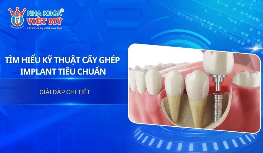 Tìm hiểu kỹ thuật cấy ghép Implant tiêu chuẩn