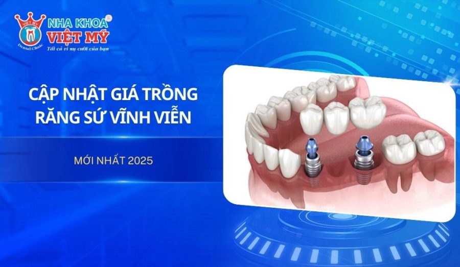 Trồng răng sứ vĩnh viễn giá bao nhiêu 2025